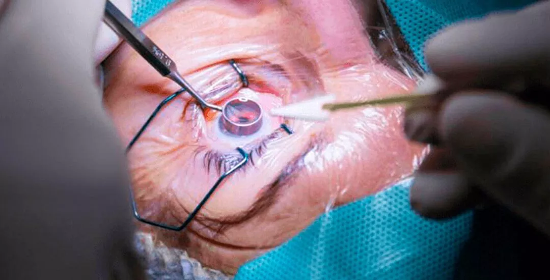 Glaucoma - Dra. Camila Porto